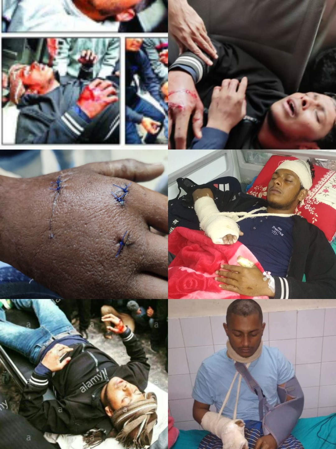 রাজনৈতিক হামলায় আহত হওয়ার একাধিক ছবির সংকলন—হাতে সেলাই, ব্যান্ডেজ ও হাসপাতালে চিকিৎসা